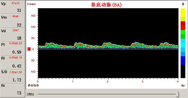 經顱多普勒檢測椎基底動脈供血障礙的表現 經顱多普勒檢測椎基底動脈供血障礙的表現